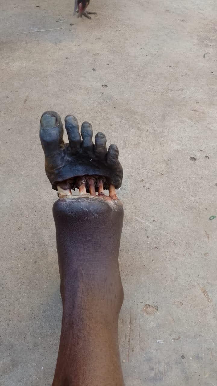 Nigerian soldier's grievous foot injury sparks sacrifice debate