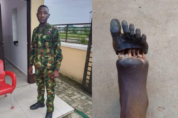 Nigerian soldier's grievous foot injury sparks sacrifice debate